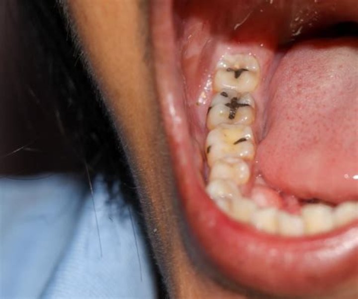 Are cavities common?