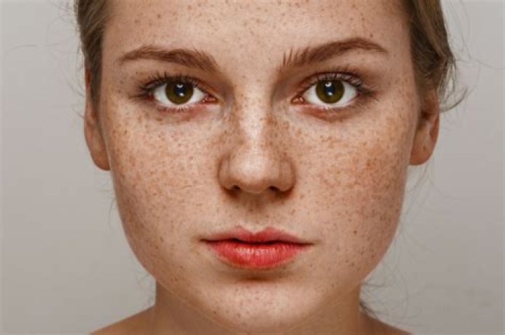 Are freckles genetic?