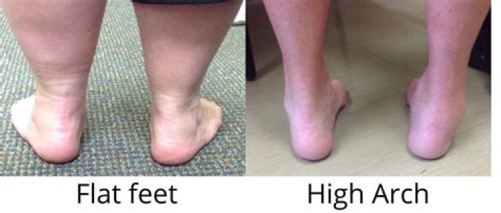Are there any perks to being flat footed?