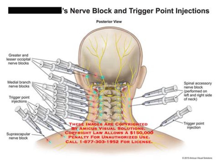 Are trigger point injections the same as nerve blocks?