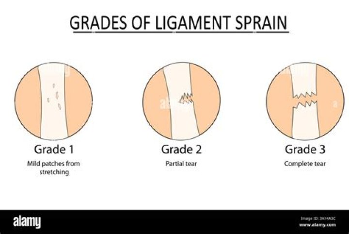 Can a grade 2 ligament tear heal on its own?