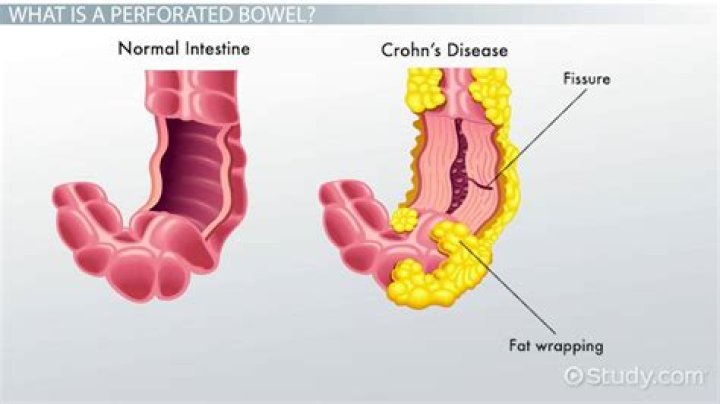 Can a perforated bowel heal on its own?