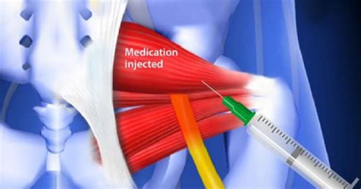 Can a steroid injection help piriformis syndrome?
