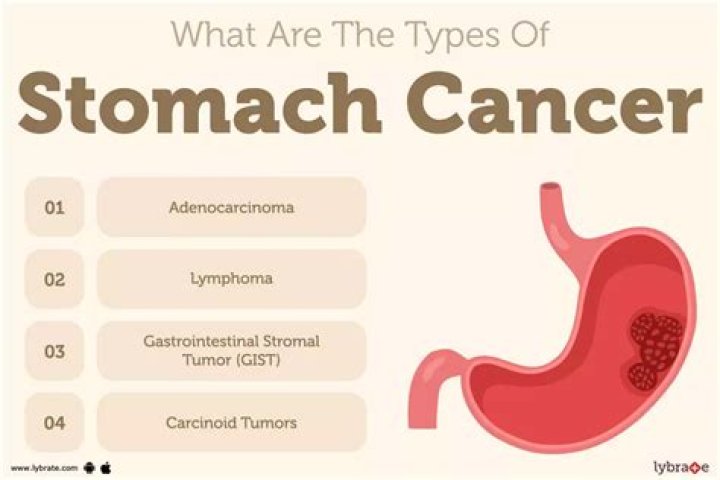 Can a tumor make your stomach big?
