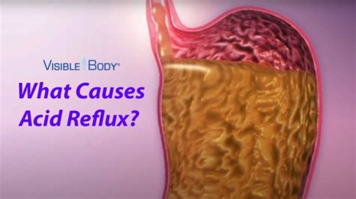 Can acid reflux affect your tongue?