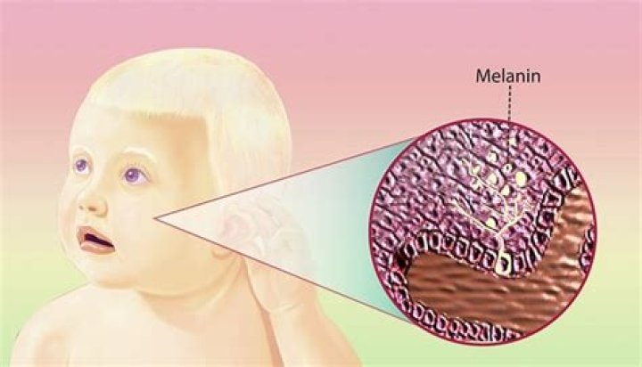 Can albinism be detected before birth?