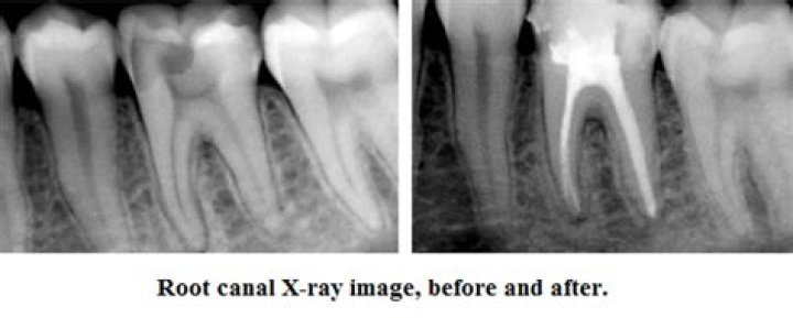 Can an xray show if you need a root canal?