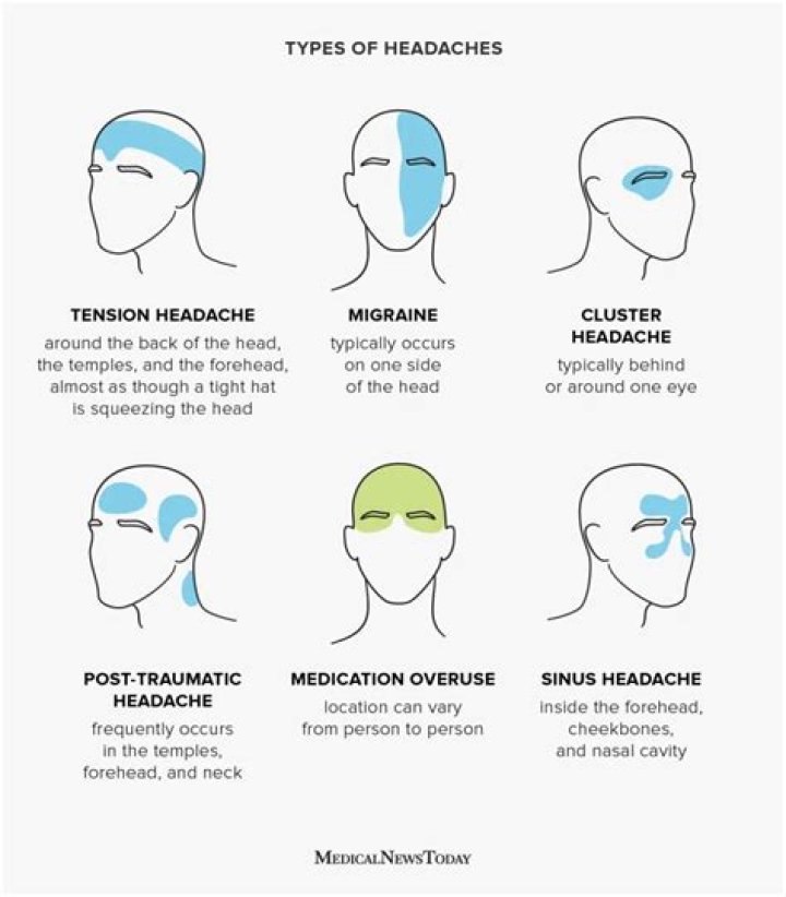 Can aneurysm headaches come and go?