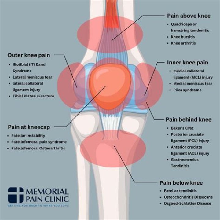 Can AVN of the hip cause knee pain?