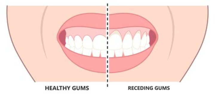 Can bleeding gums heal on its own?