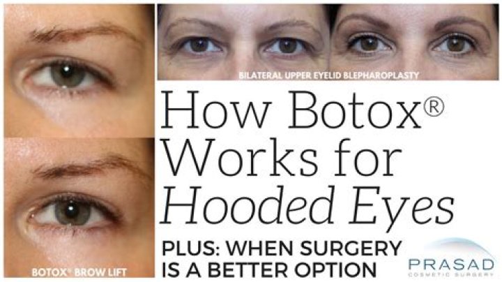 Can Botox lift hooded eyes?
