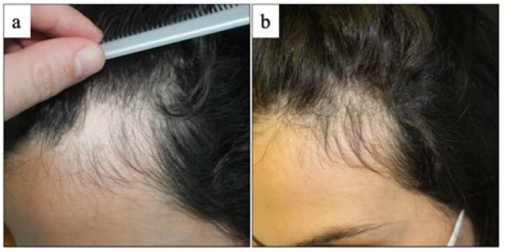 Can collagen cause alopecia?