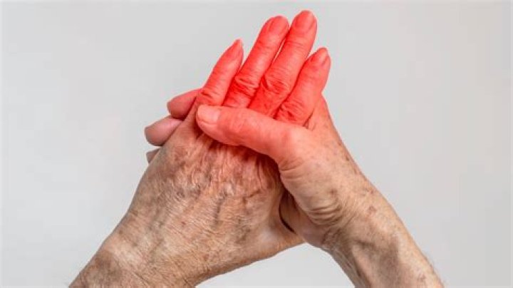 Can Covid cause arthritis flare up?