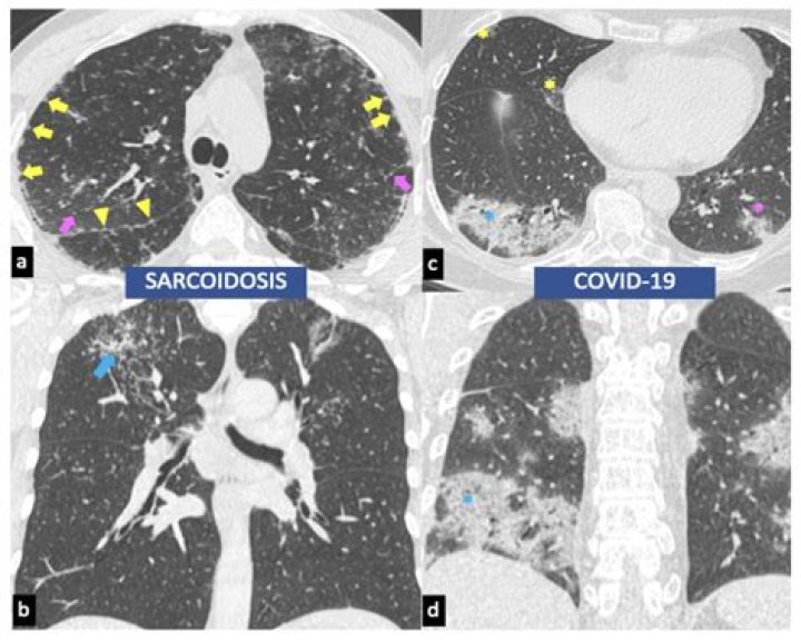 Can Covid trigger sarcoidosis?