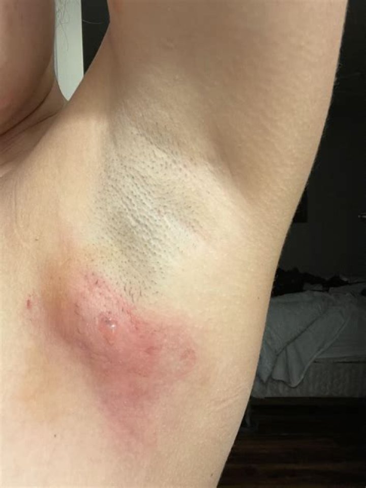 Can deodorant cause armpit boils?