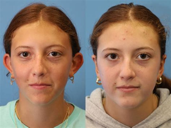 Can ears go back to normal after otoplasty?