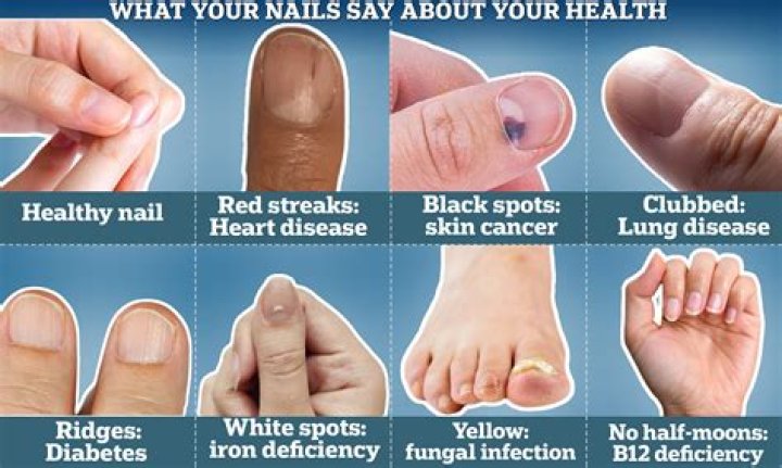 Can fingernails show signs of heart disease?
