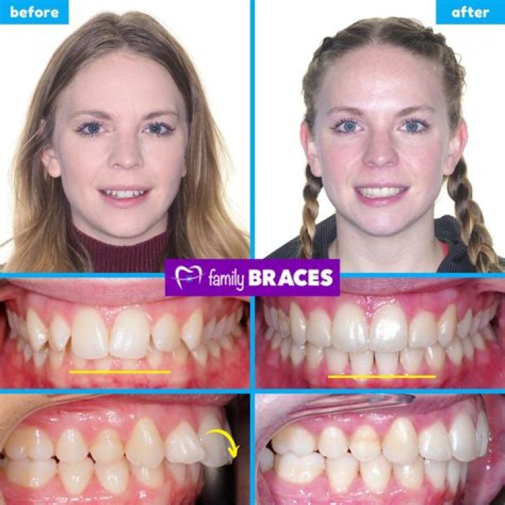 Can I get braces off early?