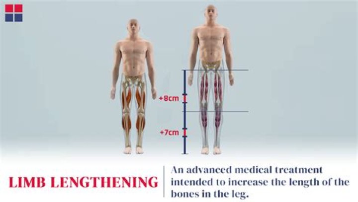 Can I get limb Lengthening surgery twice?