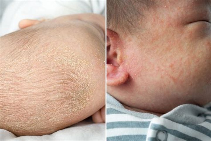Can I just leave cradle cap alone?