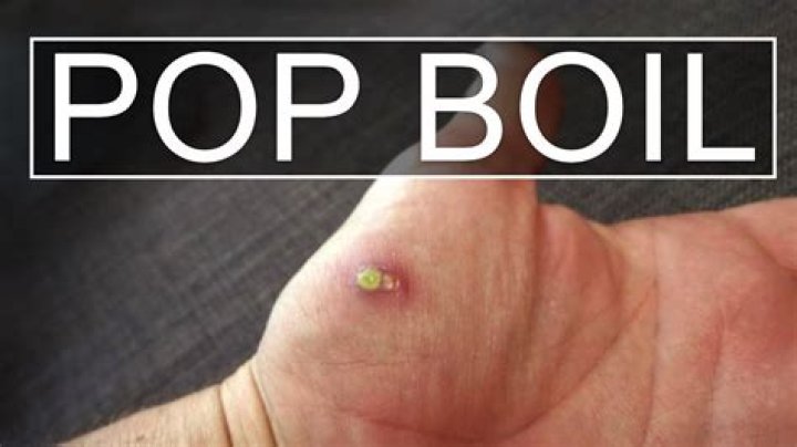Can I pop a boil?