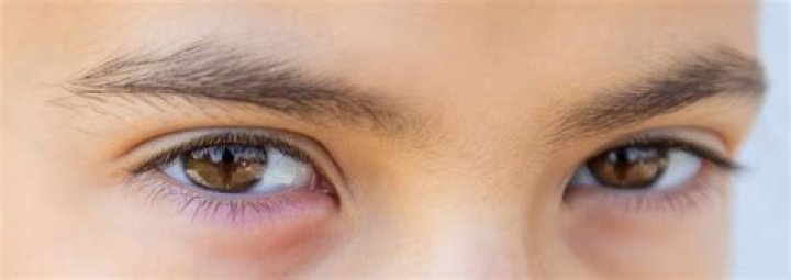 Can lack of sleep cause high eye pressure?