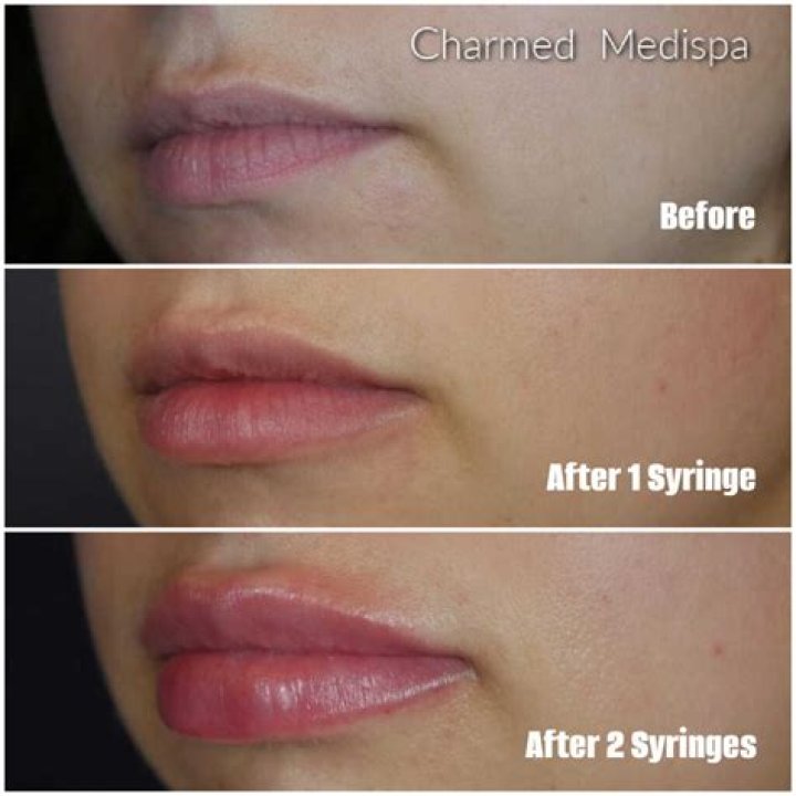 Can lip shape change?