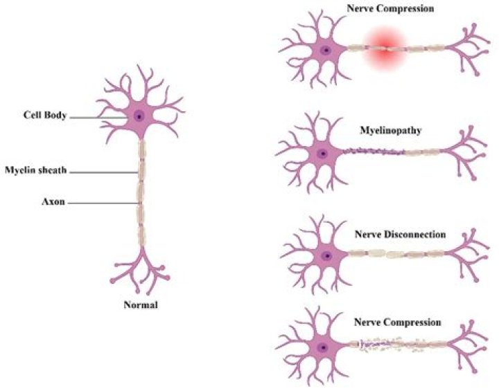Can lying down cause neuropathy?