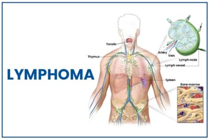 Can lymphoma be missed on CT?