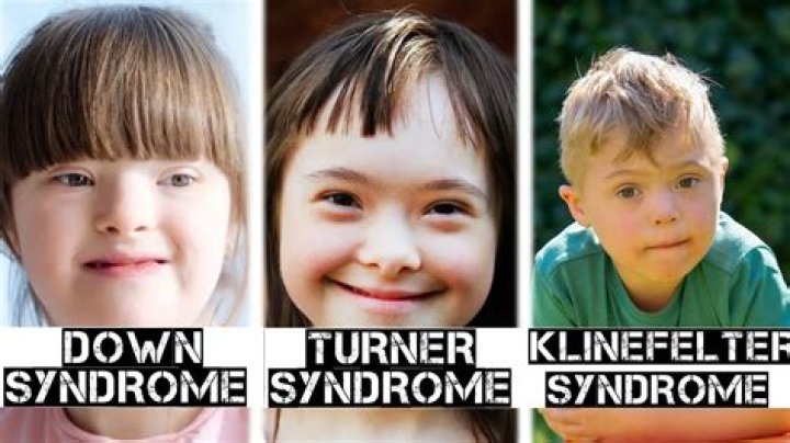 Can males have Turner syndrome?