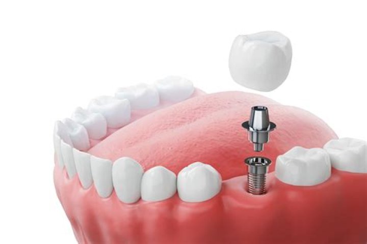 Can one implant hold 3 teeth?