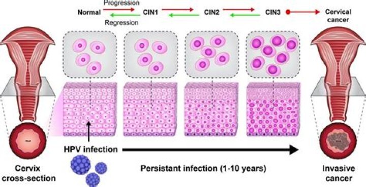 Can persistent HPV go away?