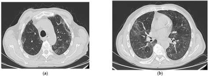 Can pulmonary fibrosis be misdiagnosed?