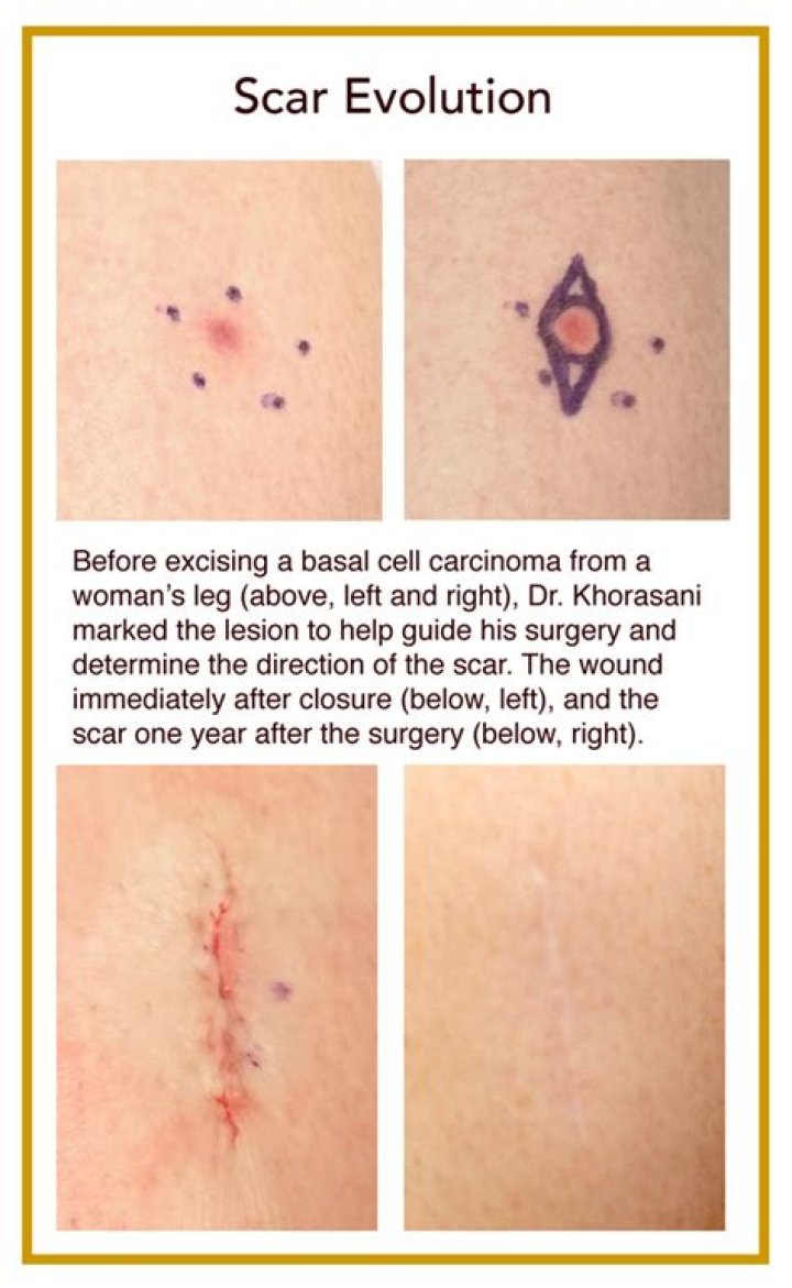 Can scar tissue become cancerous?
