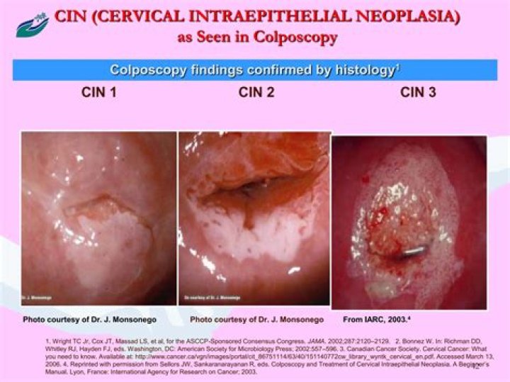 Can they numb you for a colposcopy?