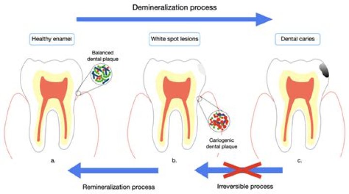 Can tooth enamel be Remineralized?