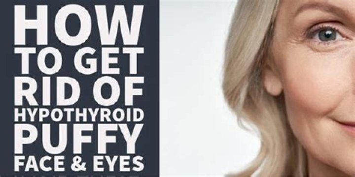 Can underactive thyroid cause dry eyes?