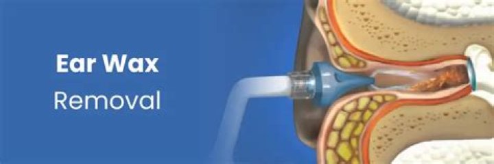 Can warm water get rid of earwax?
