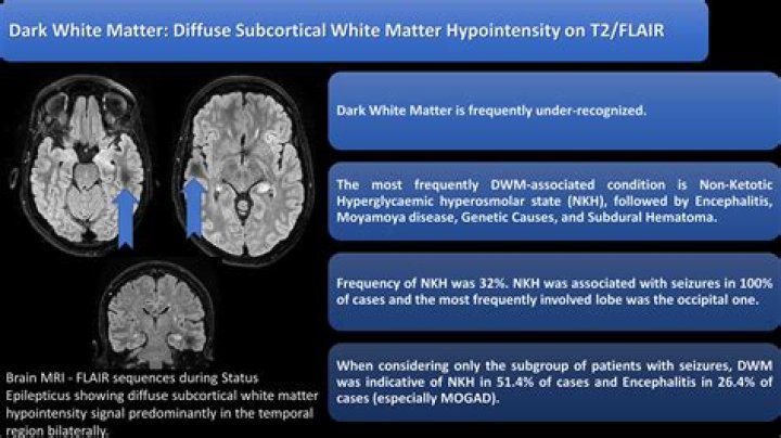 Can white matter cause dizziness?