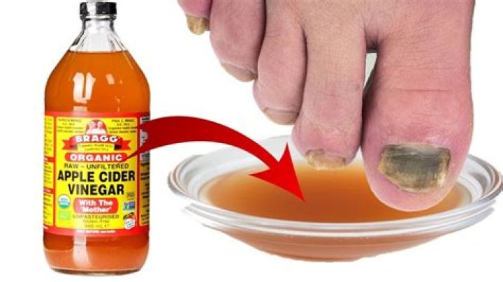 Can you apply apple cider vinegar directly to toenail fungus?