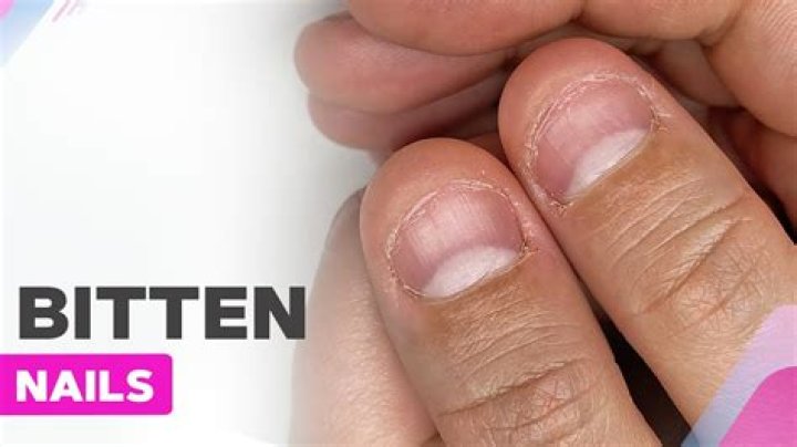 Can you bite your nails with dentures?