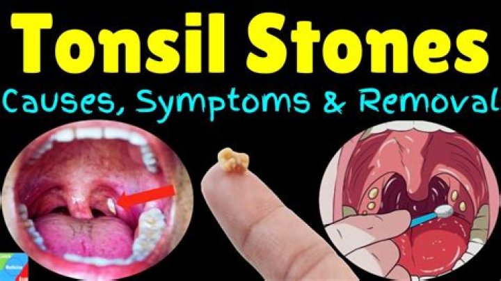 Can you feel tonsil stones?