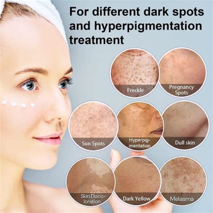 Can you fix hyperpigmentation?