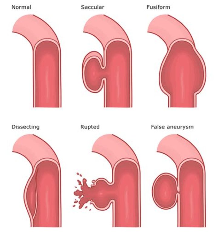 Can you get an aneurysm from whiplash?
