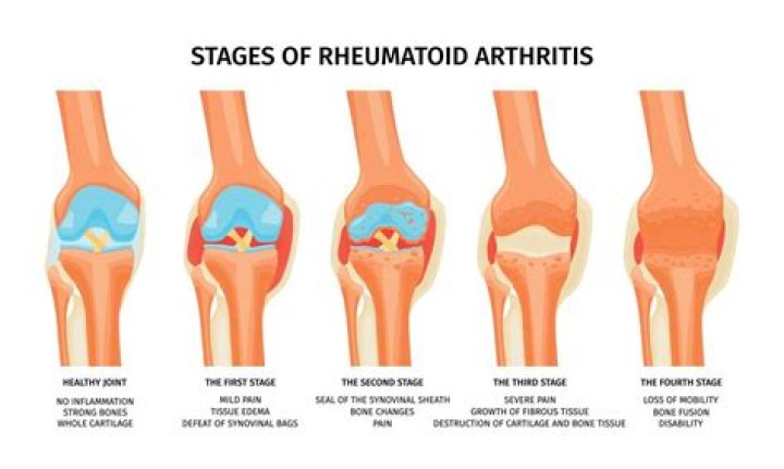 Can you get arthritis if it runs in the family?