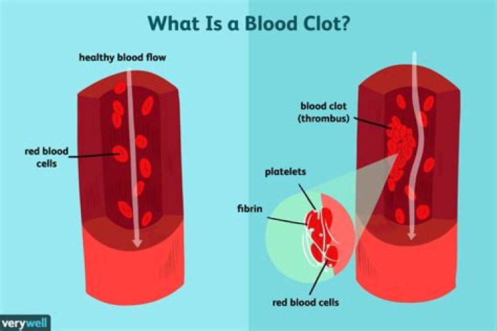 Can you have a blood clot and not know it?