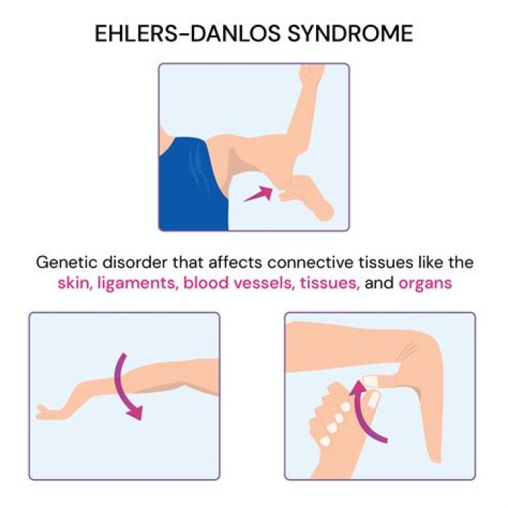Can you live a normal life with Ehlers-Danlos?