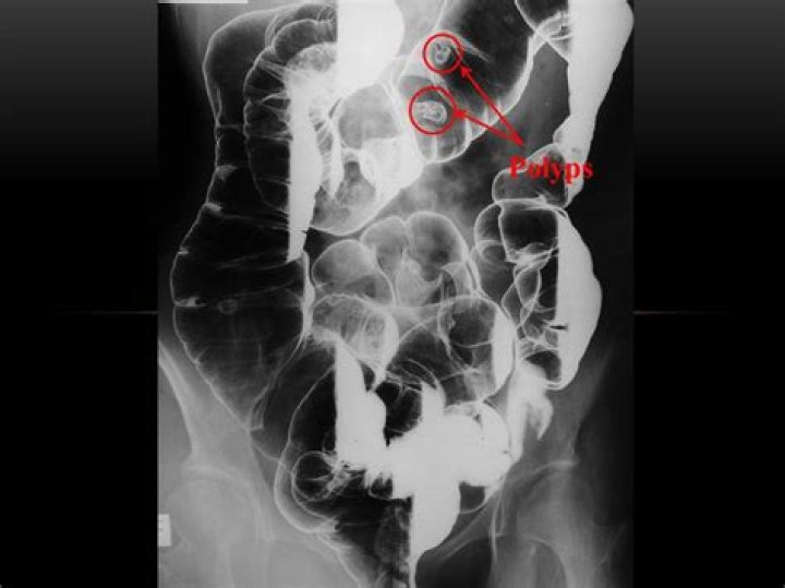 Can you see colon polyps on an ultrasound?