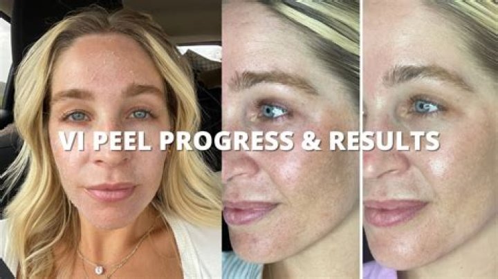 Can you see results after 1 peel?