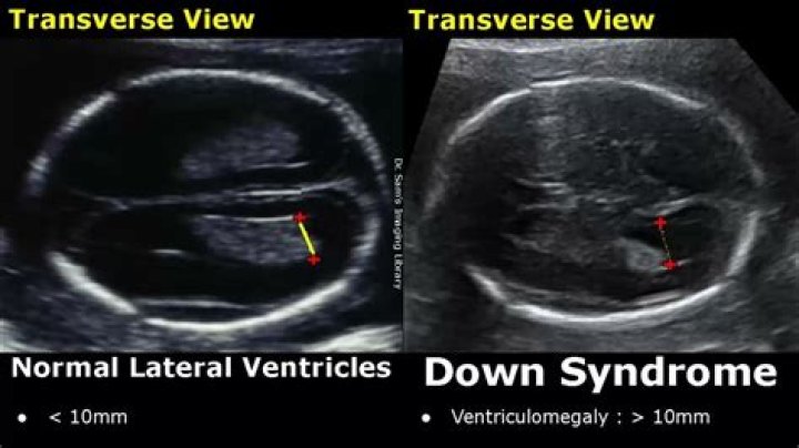 Can you see trisomy on ultrasound?